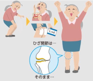 一時的に膝の痛みが取れた膝関節のイメージ