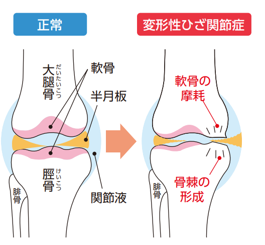 正常な膝関節と変形性膝関節症の構造イラスト