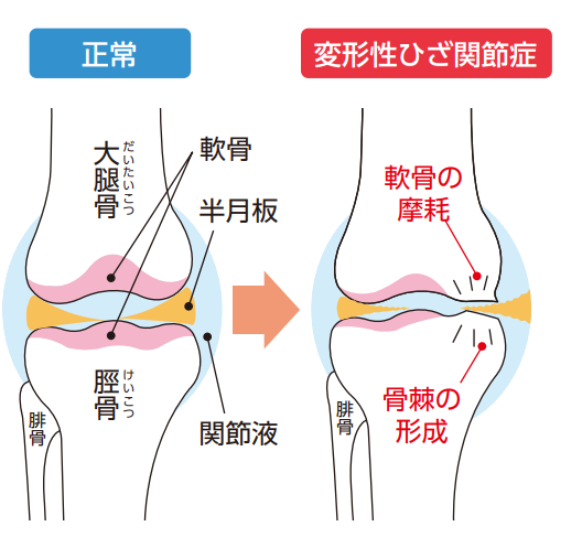 そのひざの痛みは ひざイキイキ 生化学工業株式会社