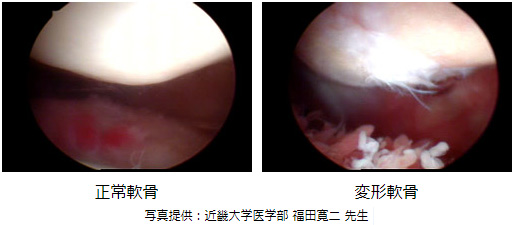 膝関節に対する関節鏡視下手術時の正常軟骨と変形軟骨の写真